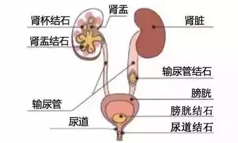 警惕保肾取石误区,科学应对肾脏健康