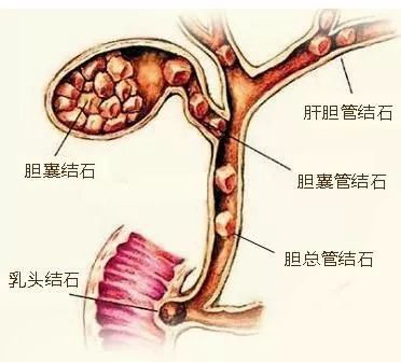 胆结石手术:避开这些常见误区,安全有效