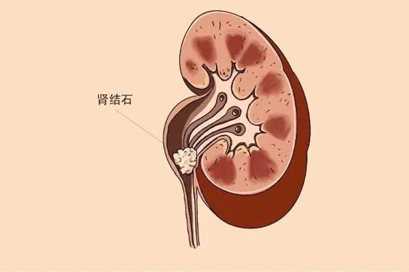 结石病困扰?重庆结石病医院的治愈之路