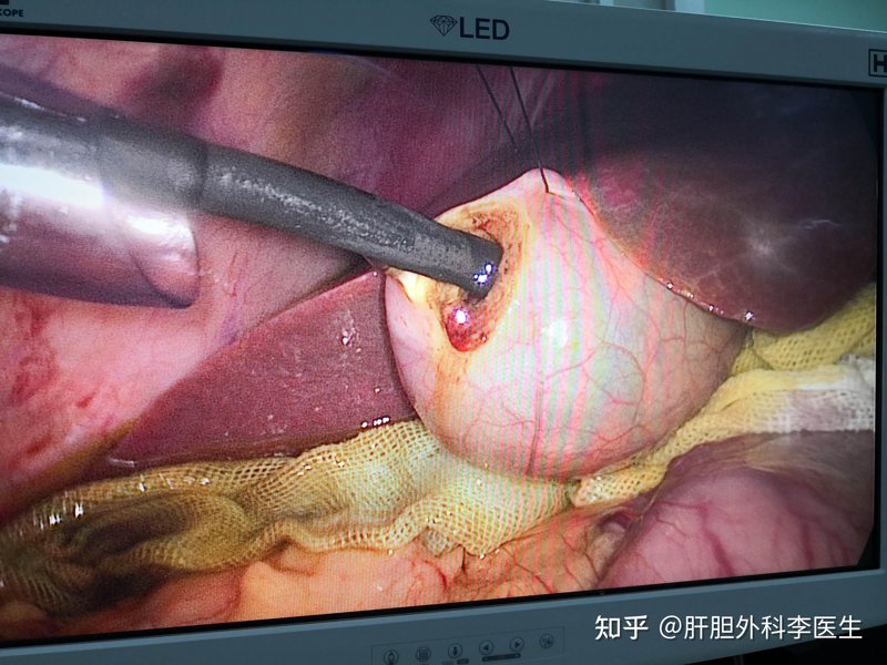 胆结石手术:常见问题解答
