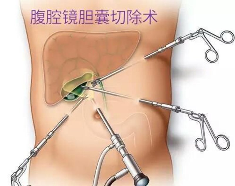 胆结石手术：常见的医疗选择与发展趋势