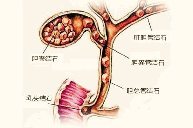 胆结石手术:趋势解读