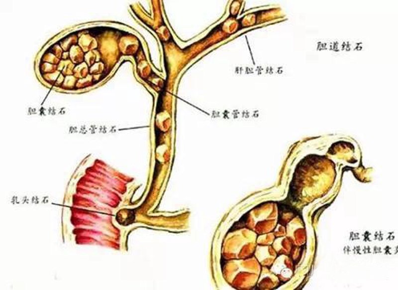 保肾取石案例分析:守护健康从细节做起