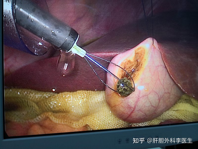 从案例看‘保肾取石’的正确打开方式