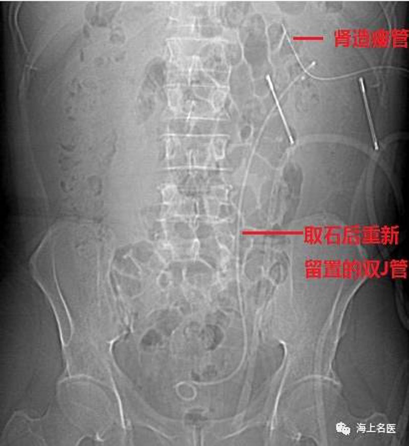 保肾取石