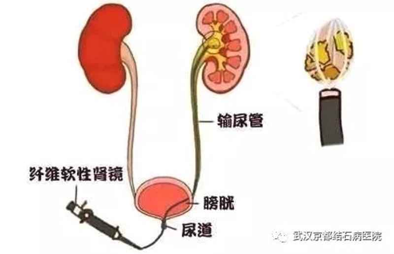 肾结石治疗误区警示:正确应对才能走出困境
