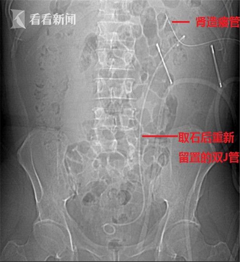 警惕保胆取石手术的常见误区